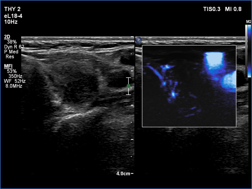 Right lobe, longitudinal scan