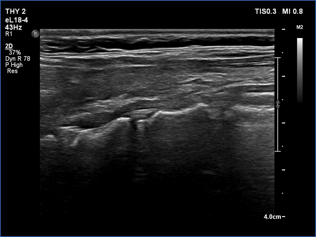Right lobe, longitudinal scan