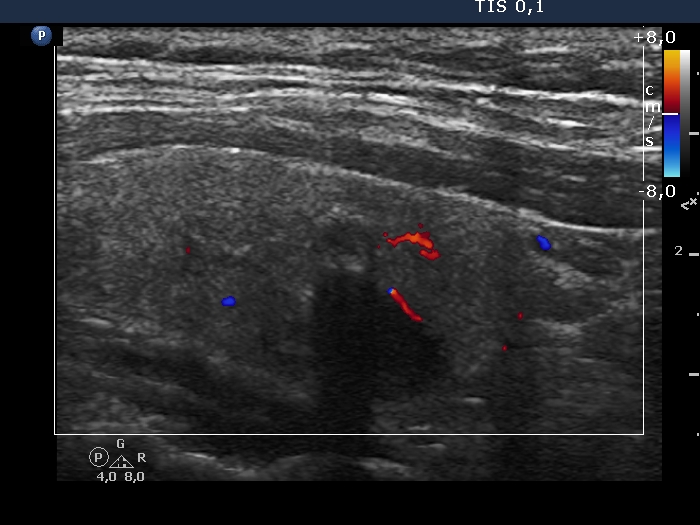 Right lobe, longitudinal scan