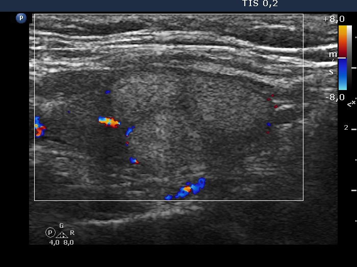 Right lobe, longitudinal scan