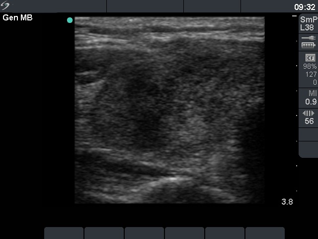 Right lobe, longitudinal scan