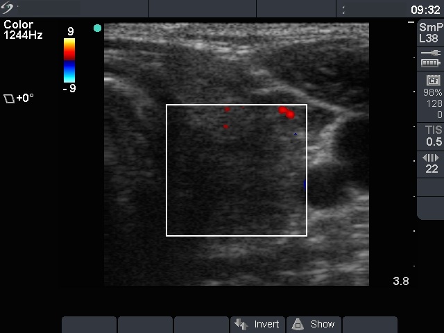 Right lobe, longitudinal scan