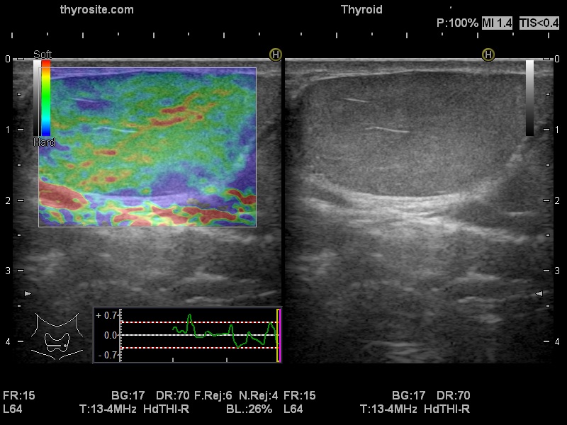 Right lobe, longitudinal scan