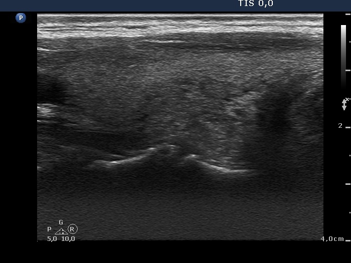 Right lobe, longitudinal scan
