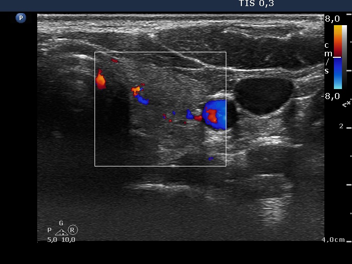 Right lobe, longitudinal scan