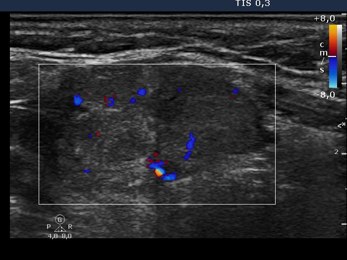 Right lobe, longitudinal scan
