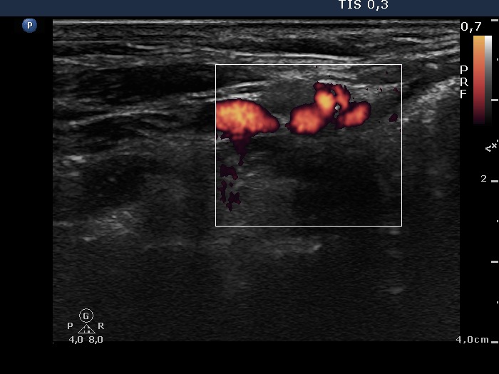 Right lobe, longitudinal scan