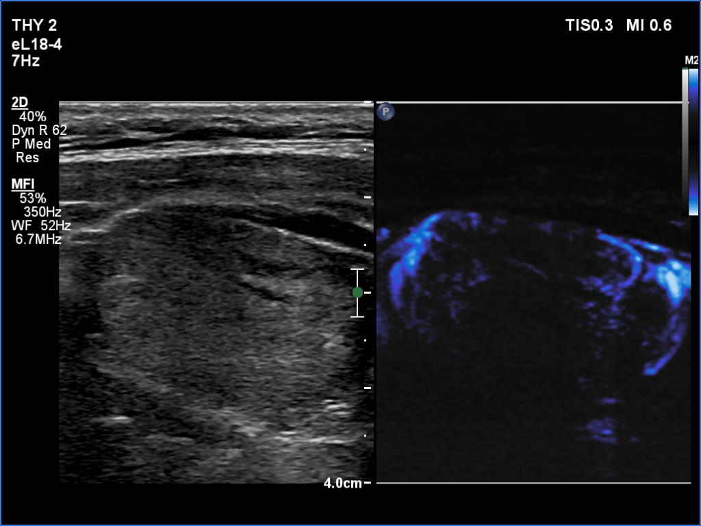 Right lobe, longitudinal scan