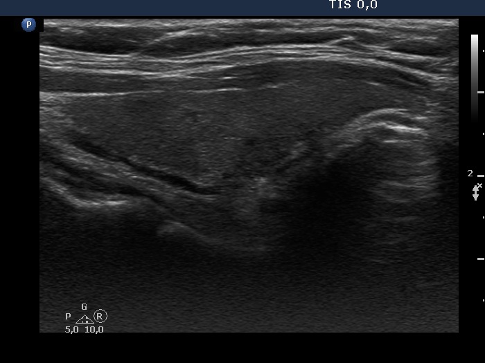 Right lobe, longitudinal scan