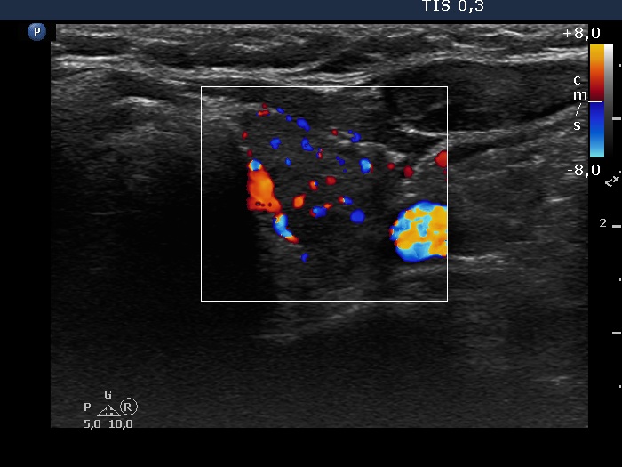 Right lobe, longitudinal scan