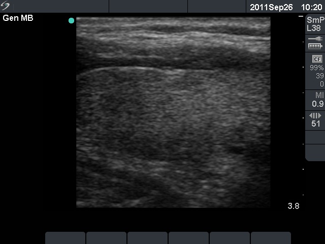 Right lobe, longitudinal scan