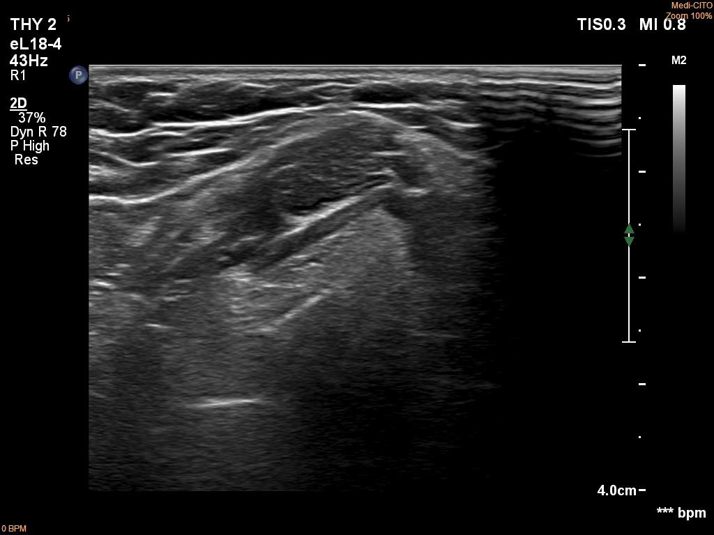 Right lobe, longitudinal scan