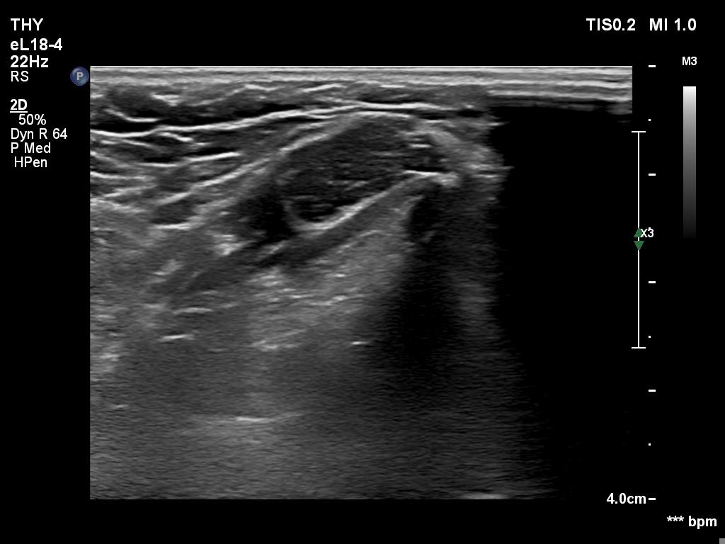 Right lobe, longitudinal scan