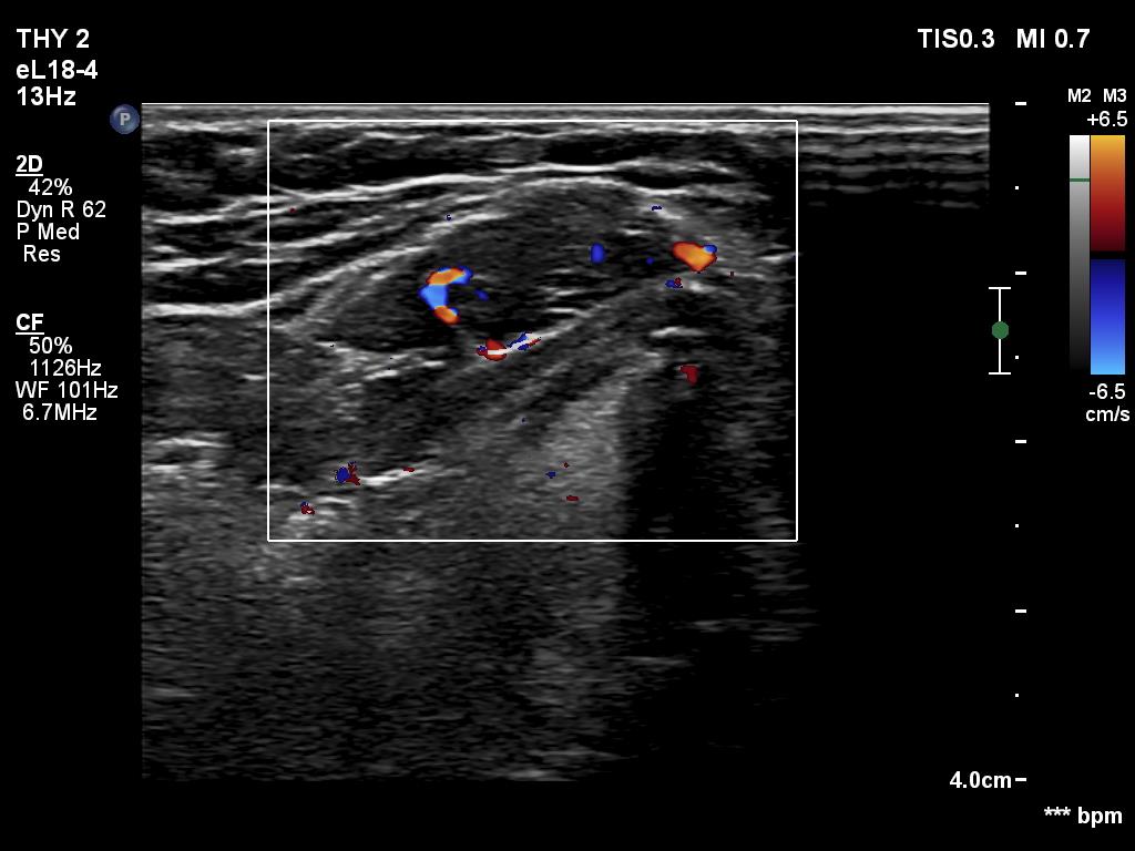 Right lobe, longitudinal scan