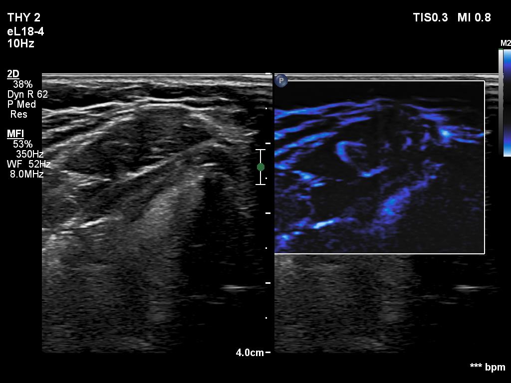 Right lobe, longitudinal scan