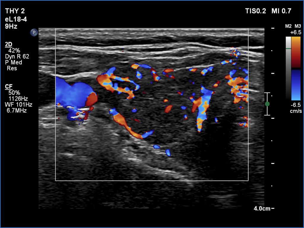Right lobe, longitudinal scan