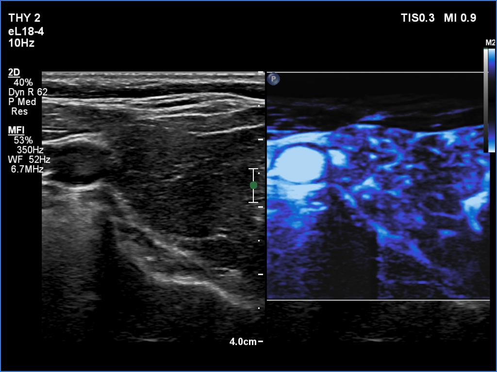 Right lobe, longitudinal scan
