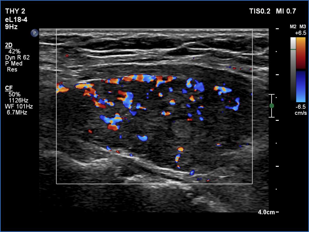 Right lobe, longitudinal scan