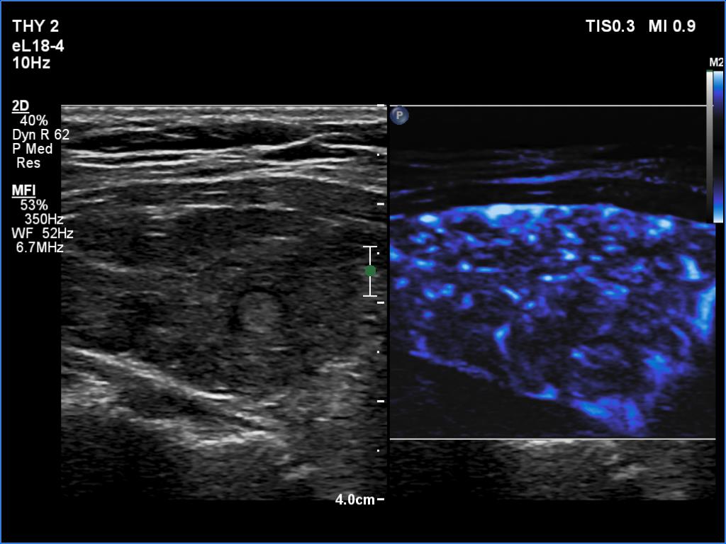 Right lobe, longitudinal scan