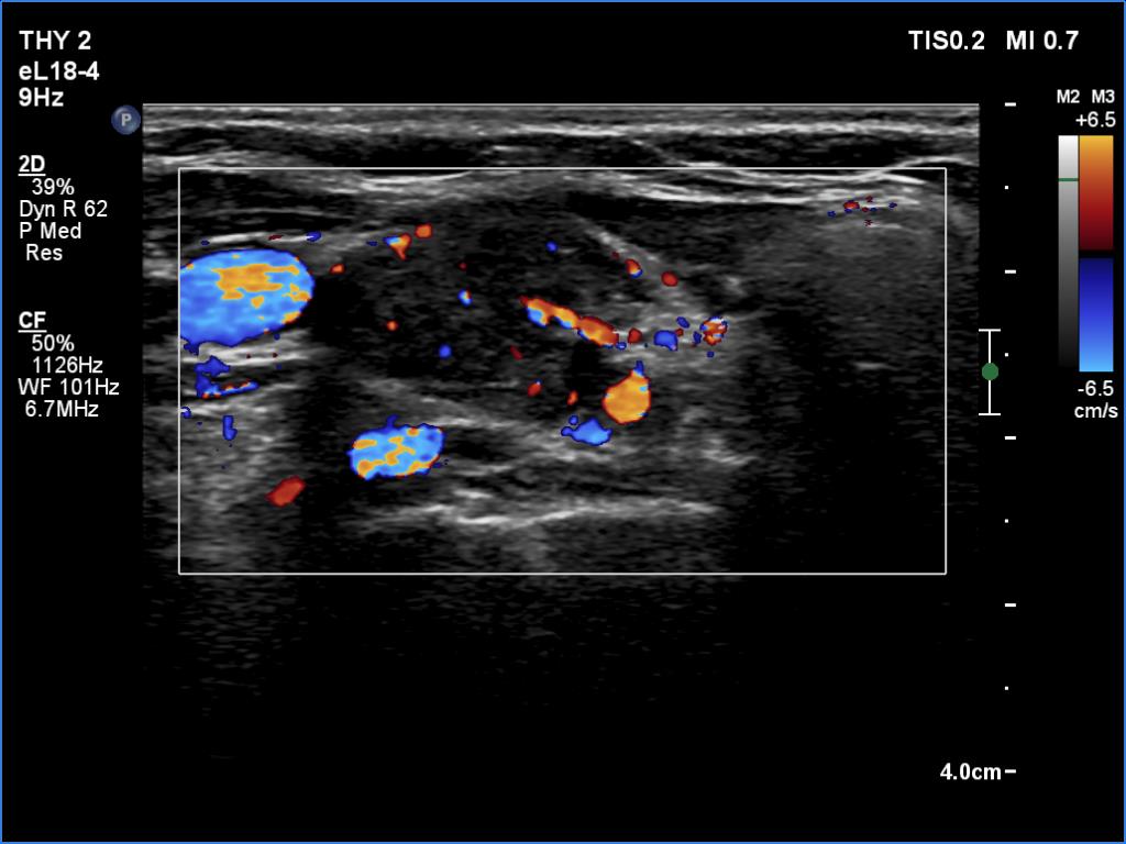 Right lobe, longitudinal scan