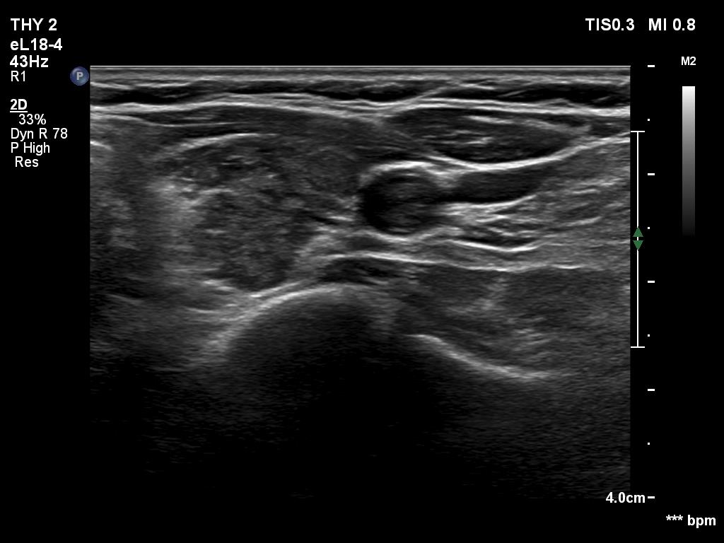 Right lobe, longitudinal scan