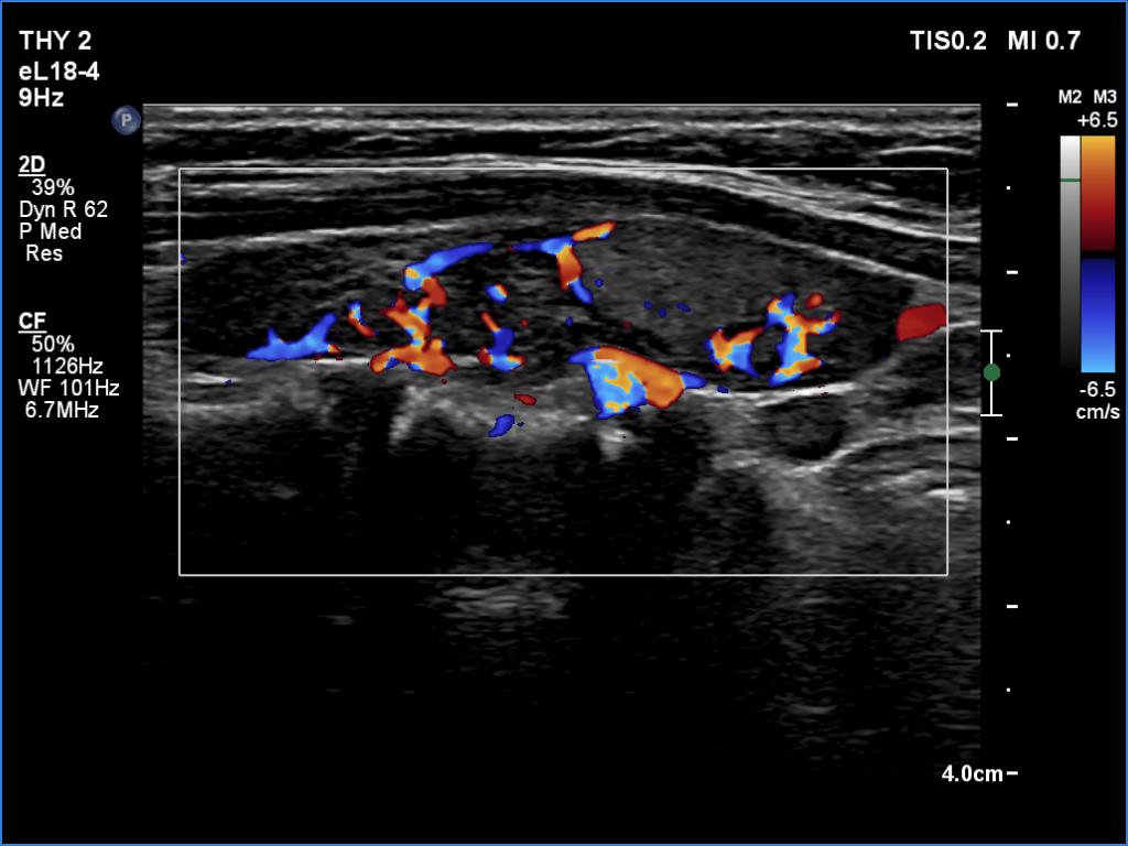 Right lobe, longitudinal scan