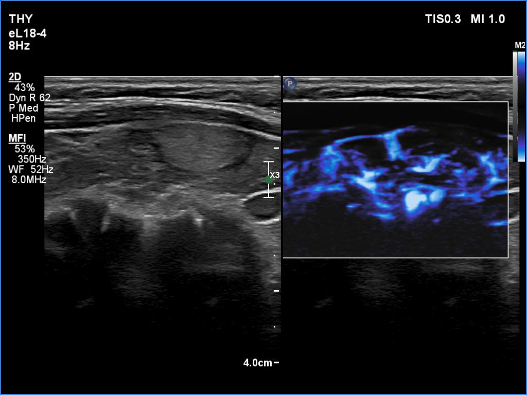 Right lobe, longitudinal scan