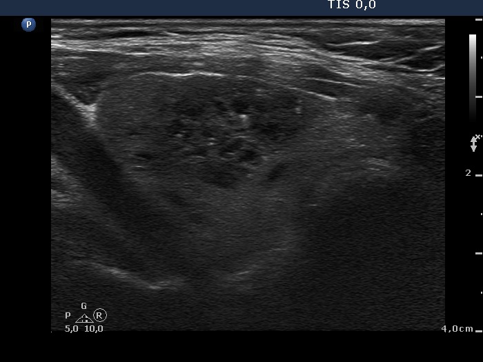 Right lobe, longitudinal scan
