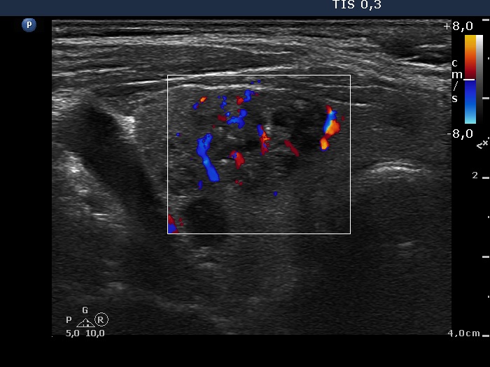 Right lobe, longitudinal scan