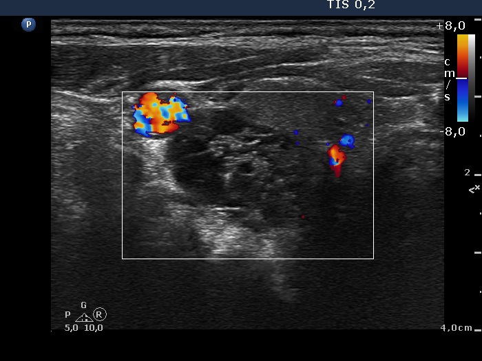 Right lobe, longitudinal scan