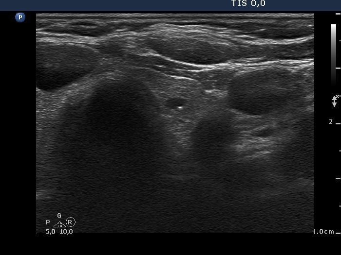 Right lobe, longitudinal scan
