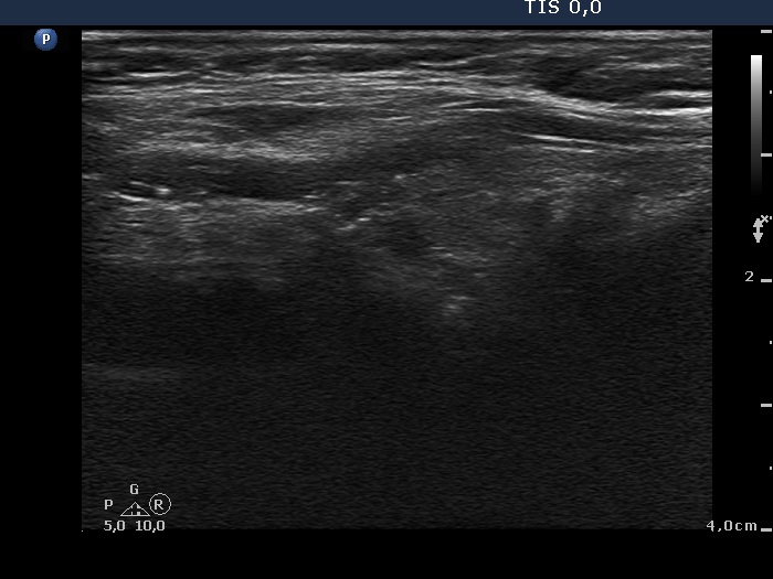 Right lobe, longitudinal scan