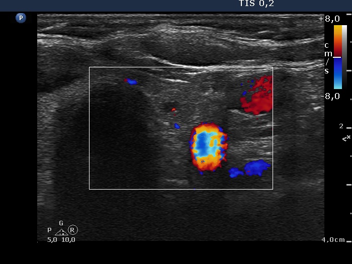 Right lobe, longitudinal scan