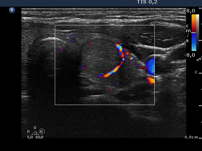 Right lobe, longitudinal scan
