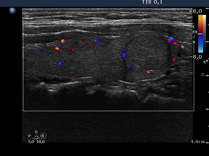 Right lobe, longitudinal scan