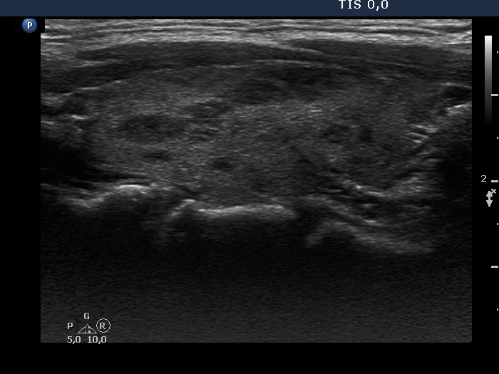 Right lobe, longitudinal scan