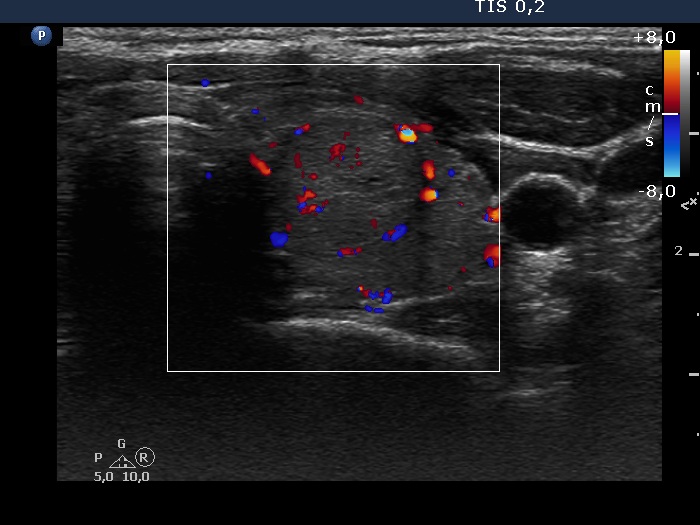 Right lobe, longitudinal scan