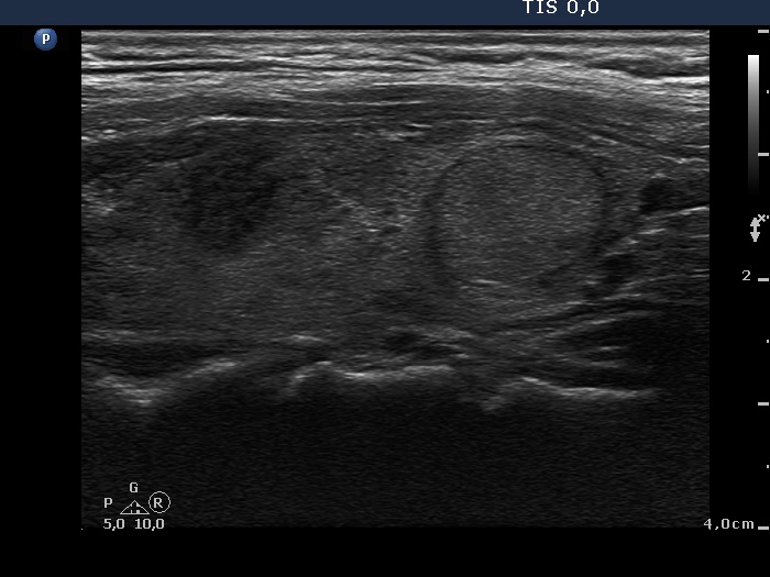 Right lobe, longitudinal scan