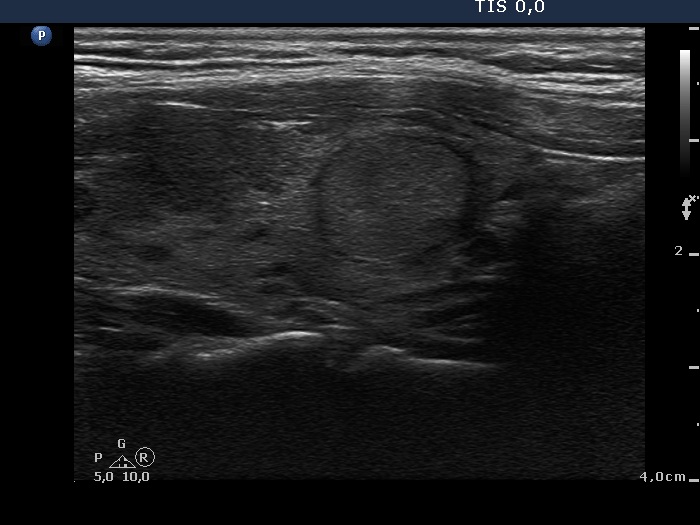 Right lobe, longitudinal scan
