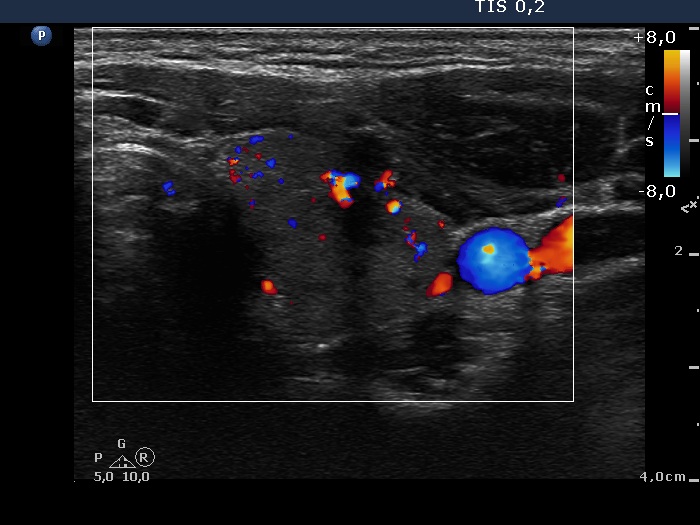 Right lobe, longitudinal scan