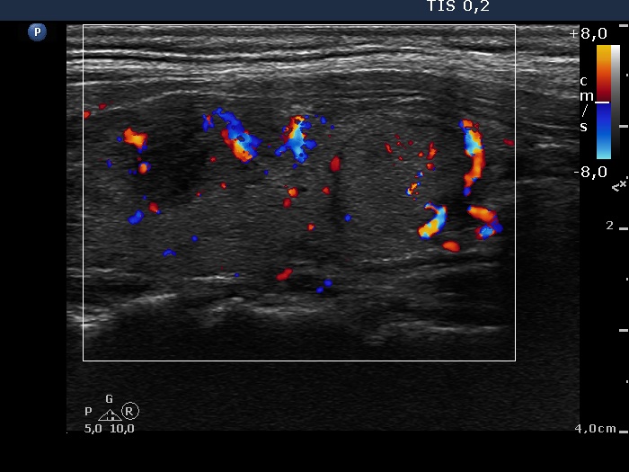 Right lobe, longitudinal scan