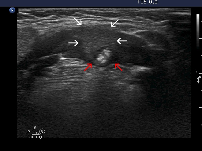 Right lobe, longitudinal scan