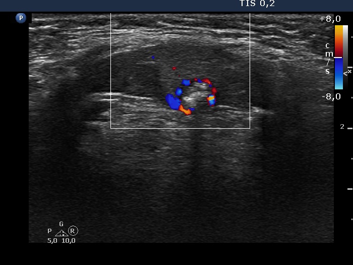 Right lobe, longitudinal scan