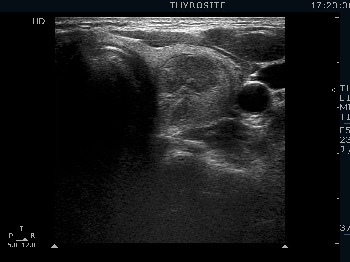 Right lobe, longitudinal scan