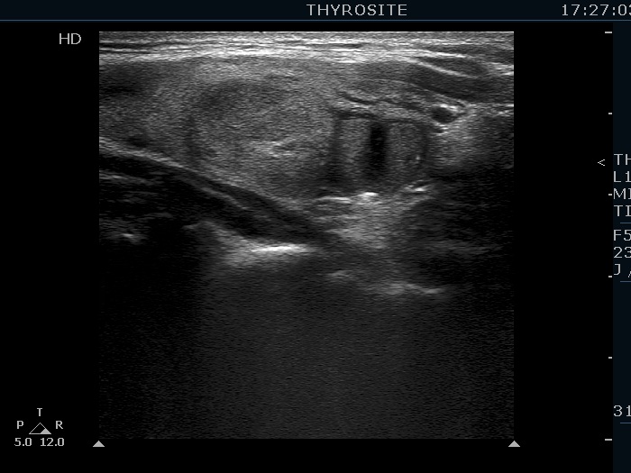 Right lobe, longitudinal scan