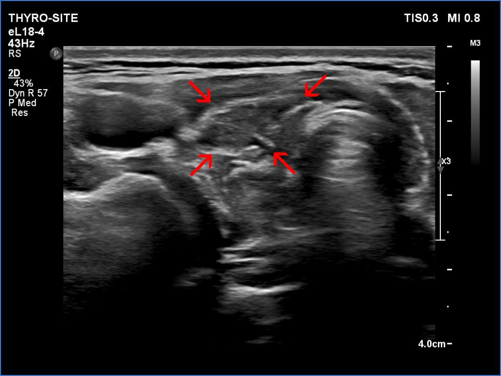 Right lobe, longitudinal scan