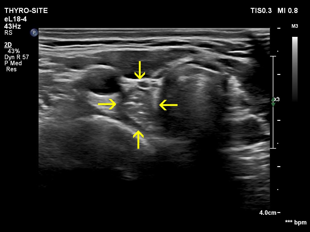 Right lobe, longitudinal scan