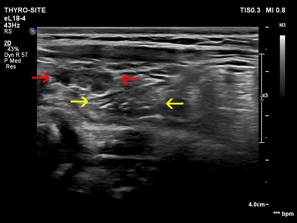 Right lobe, longitudinal scan