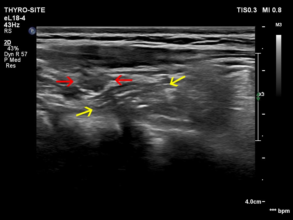 Right lobe, longitudinal scan
