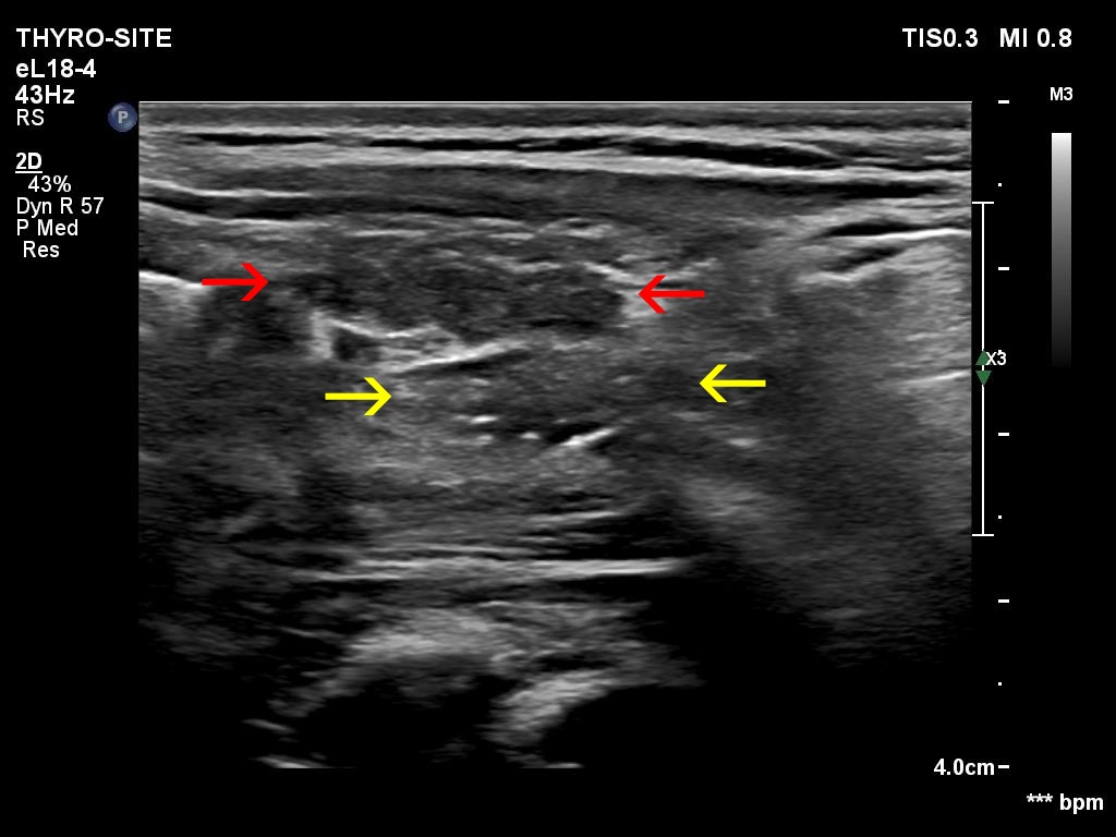 Right lobe, longitudinal scan